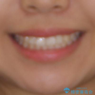 インビザライン矯正で前歯のデコボコを改善の治療前(顔貌)