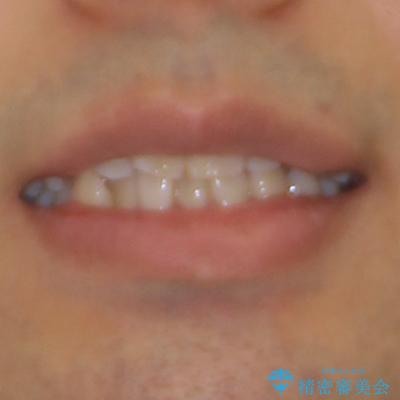 デコボコと変色した前歯　抜歯矯正と審美歯科治療の治療前（顔貌）