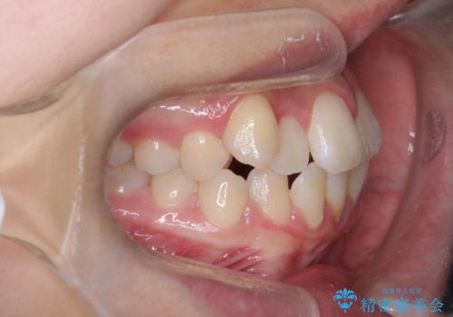 【埋伏歯】犬歯の牽引の治療前