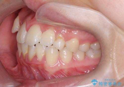 【埋伏歯】犬歯の牽引を行った矯正歯科治療の治療前