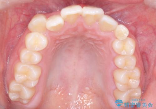 【埋伏歯】犬歯の牽引を行った矯正歯科治療の治療前