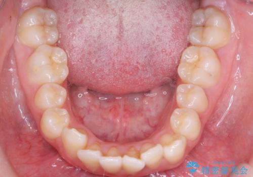 【埋伏歯】犬歯の牽引の治療前