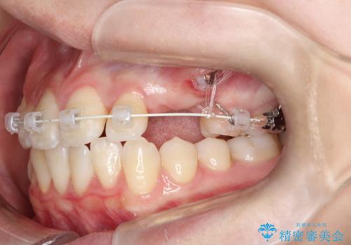 【埋伏歯】犬歯の牽引を行った矯正歯科治療