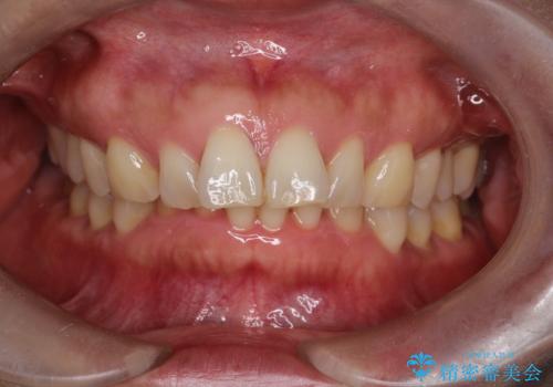 【インビザライン】出っ歯を治したいの治療前