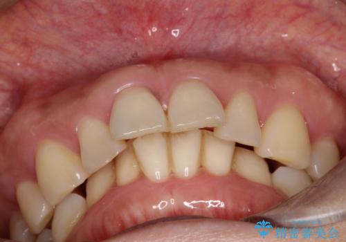 【インビザライン】出っ歯を治したいの治療前