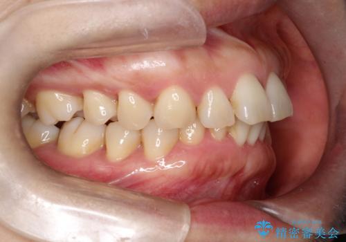 【インビザライン】出っ歯を治したいの治療前