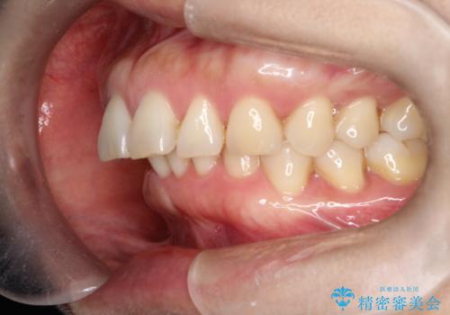 【インビザライン】出っ歯を治したいの治療前