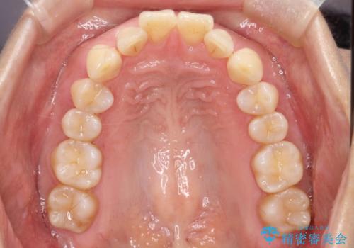 【インビザライン】出っ歯を治したいの治療前