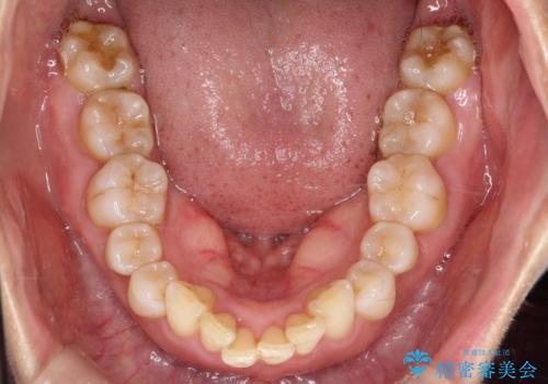【インビザライン】出っ歯を治したいの治療前