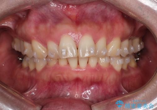 【インビザライン】出っ歯を治したいの治療中