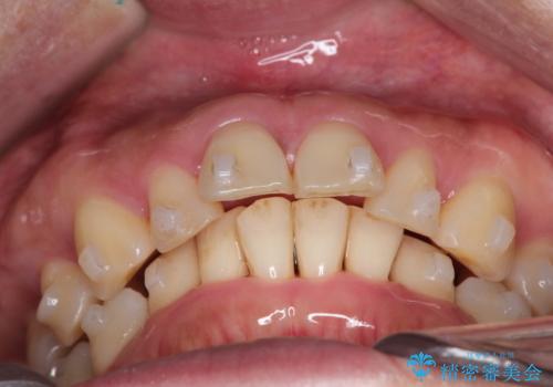 【インビザライン】出っ歯を治したいの治療中