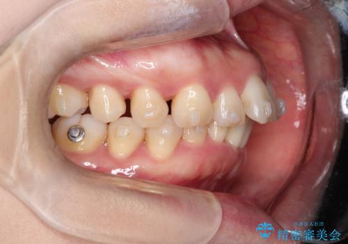 【インビザライン】出っ歯を治したいの治療中
