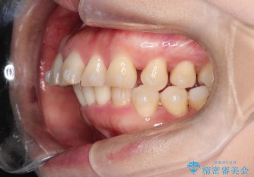 【インビザライン】出っ歯を治したいの治療中