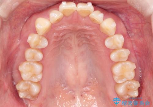 【インビザライン】出っ歯を治したいの治療中