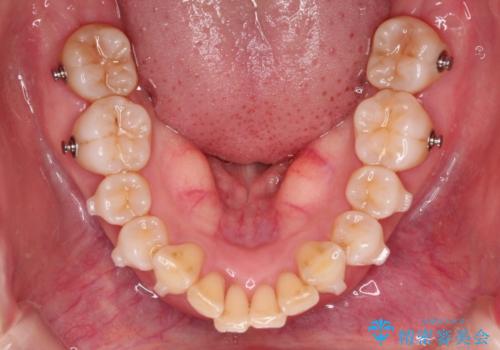 【インビザライン】出っ歯を治したいの治療中