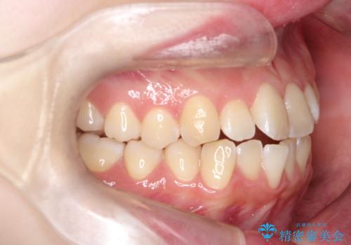 【インビザライン】オープンバイト。凸凹を治したいの治療前