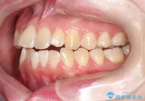 【インビザライン】オープンバイト。凸凹を治したいの治療前