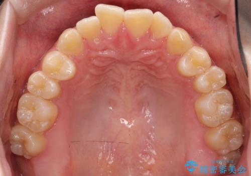 【インビザライン】オープンバイト。凸凹を治したいの治療前