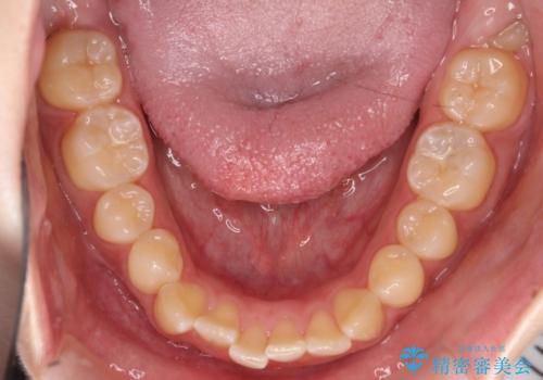 【インビザライン】オープンバイト。凸凹を治したいの治療前