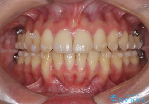【インビザライン】アンカースクリューを用いた遠心移動の治療中