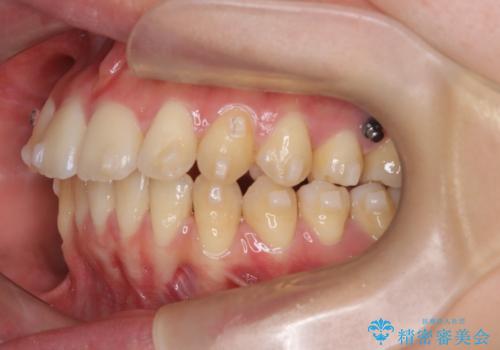 【インビザライン】アンカースクリューを用いた遠心移動の治療中