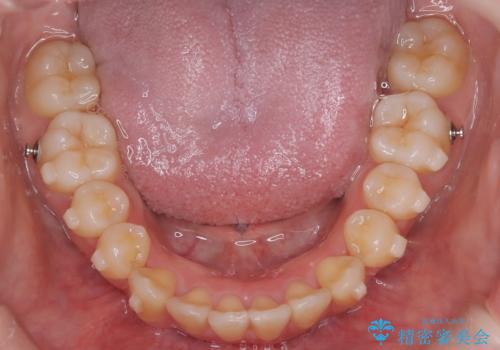 【インビザライン】アンカースクリューを用いた遠心移動の治療中