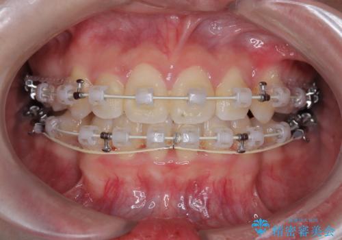 【埋伏歯】犬歯の牽引を行った矯正歯科治療の治療中