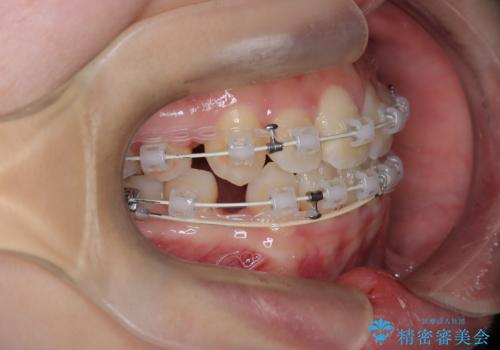 【埋伏歯】犬歯の牽引を行った矯正歯科治療の治療中