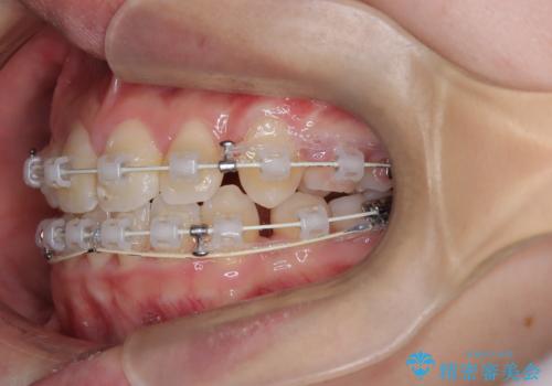 【埋伏歯】犬歯の牽引を行った矯正歯科治療の治療中