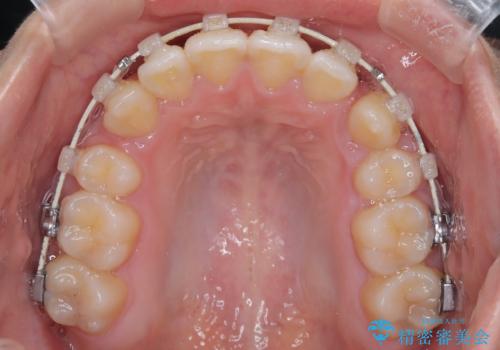 【埋伏歯】犬歯の牽引を行った矯正歯科治療の治療中