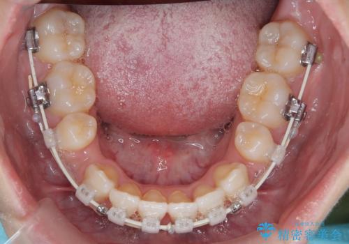 【埋伏歯】犬歯の牽引を行った矯正歯科治療の治療中