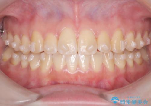 【インビザライン】オープンバイト。凸凹を治したいの治療中
