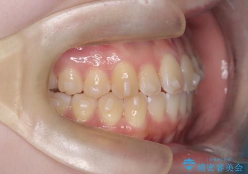 【インビザライン】オープンバイト。凸凹を治したいの治療中