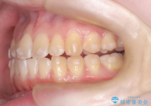 【インビザライン】オープンバイト。凸凹を治したいの治療中