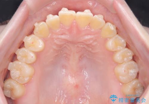【インビザライン】オープンバイト。凸凹を治したいの治療中