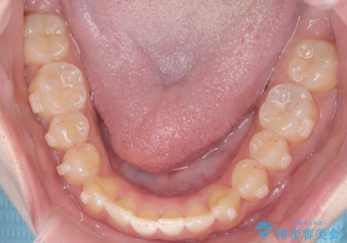 【インビザライン】オープンバイト。凸凹を治したいの治療中