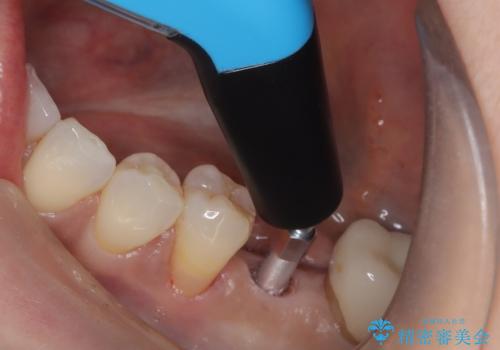 歯の破折　食べる喜びが蘇るインプラント治療の治療中
