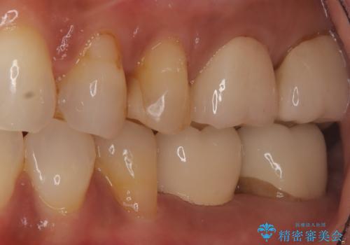 歯の破折 食べる喜びが蘇るインプラント治療の治療後