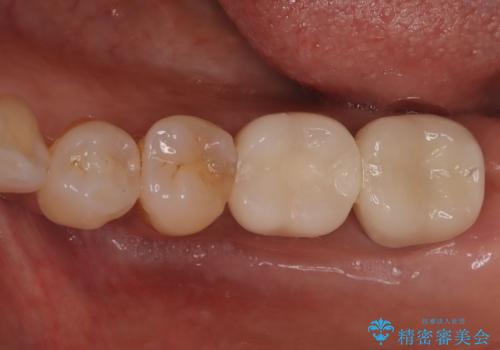 歯の破折 食べる喜びが蘇るインプラント治療の治療後