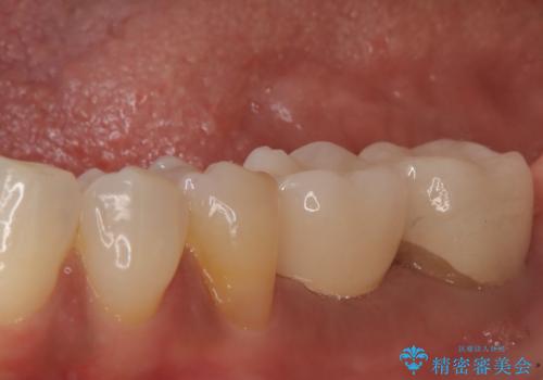 歯の破折 食べる喜びが蘇るインプラント治療の症例 治療後