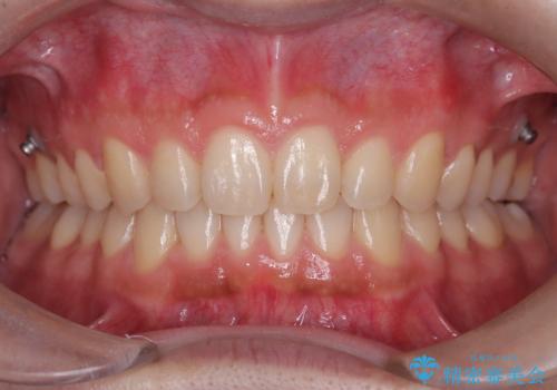 【インビザライン】ディープバイトを治したいの症例 治療後