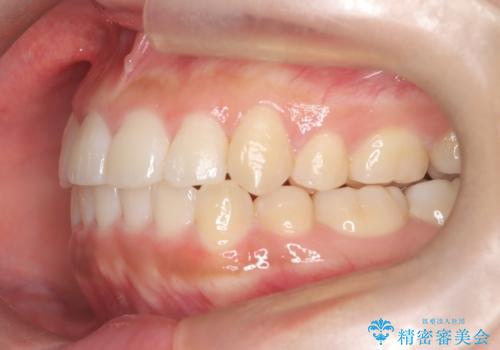 美しい口元へ、短期間で綺麗な歯並びに変身の治療後