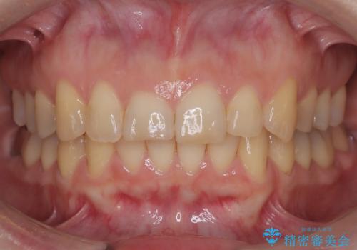 インビザライン矯正　前歯のガタツキが治り、綺麗なスマイルに!の症例 治療後