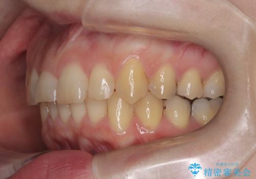 インビザライン矯正　前歯のガタツキが治り、綺麗なスマイルに!の治療後