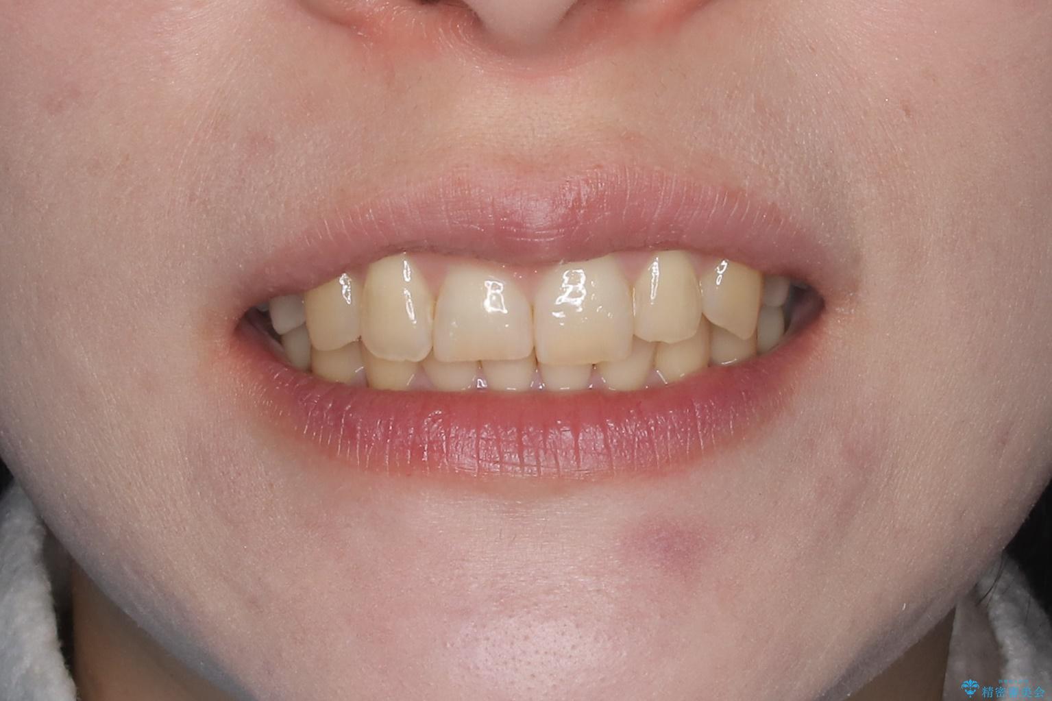 インビザライン矯正　前歯のガタツキが治り、綺麗なスマイルに!の治療後（顔貌）