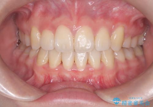 【埋伏歯】犬歯の牽引を行った矯正歯科治療の治療後