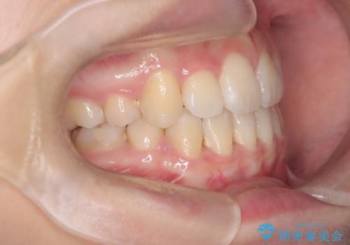 【埋伏歯】犬歯の牽引の治療後