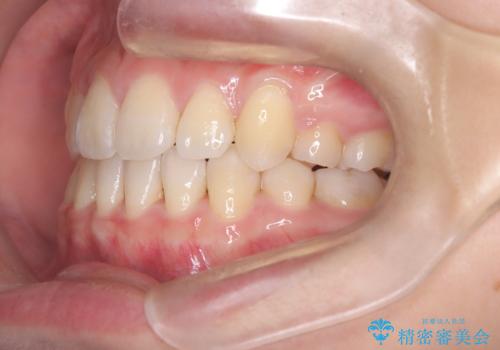 【埋伏歯】犬歯の牽引を行った矯正歯科治療の治療後