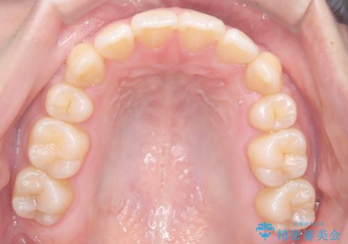 【埋伏歯】犬歯の牽引を行った矯正歯科治療の治療後