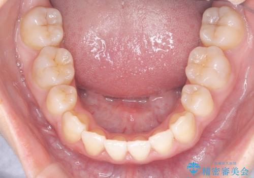 【埋伏歯】犬歯の牽引を行った矯正歯科治療の治療後